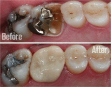 Dental Crowns Dental Crowns - before and after