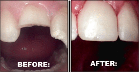 Dental Bridges Dental Crowns - before and after pictures