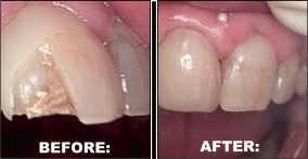 Dental Bridges Dental Crown before and after pictures