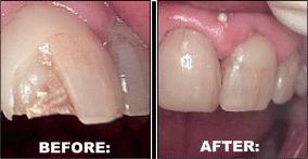 Dental Bridges